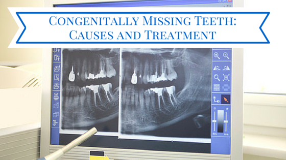 Congenitally Missing Teeth