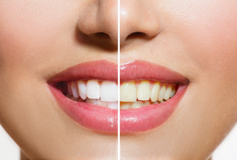 How Teeth Whitening Can Help Your Career & Social Life